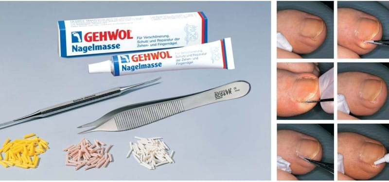 rurki_protektor__sulci (Custom).jpg